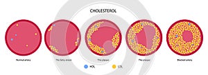 Cholesterol blood artery