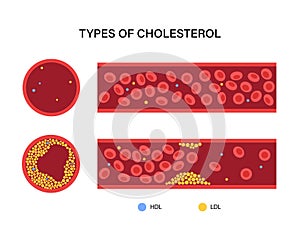 Cholesterol blood artery