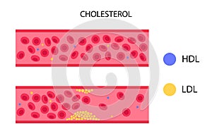 Cholesterol blood artery