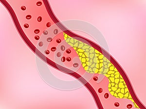Cholesterol in blood vessel blocking flow of blood