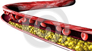 Cholesterol formation, fat. 3d section of an artery, vein and red blood cells, heart