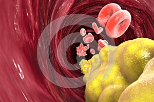 Cholesterol formation, fat, artery, vein, heart