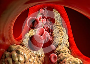 Cholesterol formation, fat, artery, vein, heart. Red blood cells, blood flow. Narrowing of a vein for fat formation