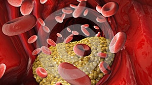 Cholesterol formation, fat, artery, vein. Red blood cells, blood flow. Narrowing of a vein for fat formation