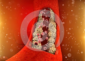 Cholesterol formation, fat, artery, vein, heart. Red blood cells, blood flow. Narrowing of a vein for fat formation