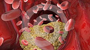 Cholesterol formation, fat, artery, vein. Red blood cells, blood flow. Narrowing of a vein for fat formation