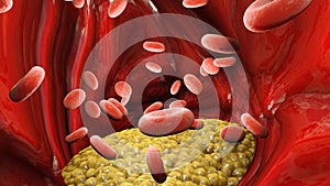 Cholesterol formation, fat, artery, vein. Red blood cells, blood flow. Narrowing of a vein for fat formation photo