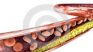 Cholesterol formation, fat. 3d section of an artery, vein and red blood cells, heart