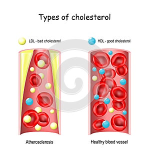 Cholesterol. HDL and LDL lipoprotein