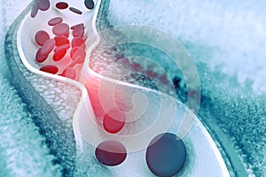 Cholesterol plaque in artery