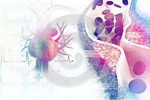 Cholesterol plaque in artery