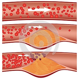 Placa de colesterol en las arterias (aterosclerosis) la ilustración.