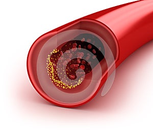 Cholesterol plaque in artery