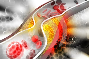 Cholesterol plaque in artery