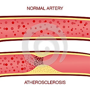 Cholesterol plaque in artery atherosclerosis illustration