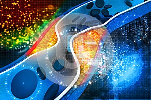 Cholesterol plaque in artery