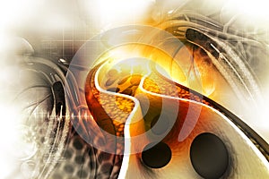 Cholesterol plaque in artery