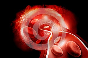 Cholesterol plaque in artery