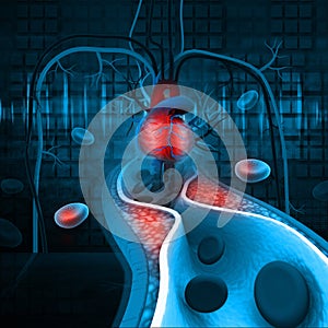 Cholesterol plaque in artery