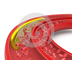 Cholesterol plaque in artery, stent angioplasty