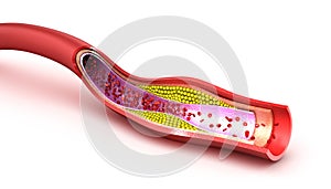 Cholesterol plaque in blood vessel