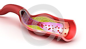 Cholesterol plaque in blood vessel