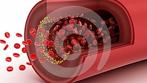 Cholesterol plaque in blood vessel