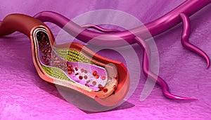 Cholesterol plaque in blood vessel