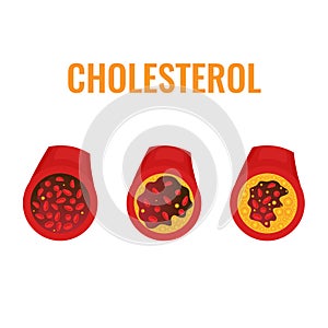 Cholesterol plaque in blood vessel medical diagram