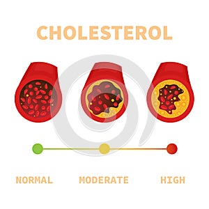 Cholesterol plaque in blood vessel medical diagram