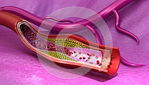 Cholesterol plaque in blood vessel , Medically accurate