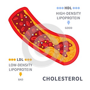 Cholesterol plaque buildup in blocked artery diagram