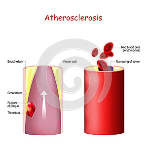 Cholesterol. Thrombus formation in an atherosclerotic vessel