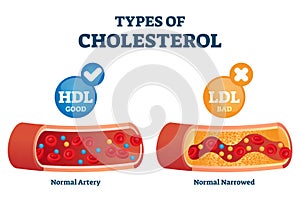 Cholesterol types comparison with HDL and LDL lipoprotein vector illustration photo