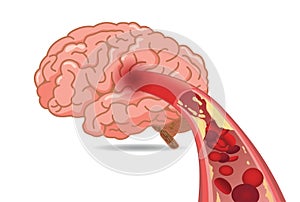Cholesterol in veins made slow blood flow into brain.