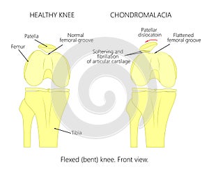 Chondromalacia patella. Flattened femoral groove