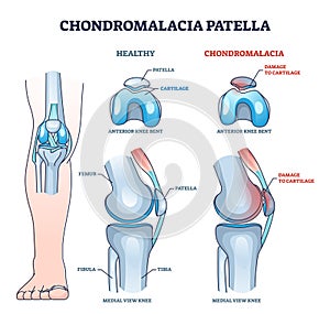 Chondromalacia patella knee breakdown compared with healthy outline diagram