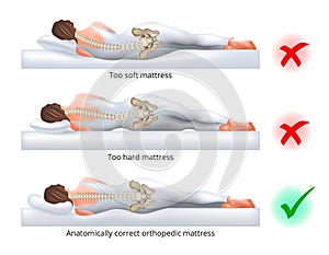 Choosing an orthopedic mattress for sleeping - Correct and incorrect sleeping position on the side, vector illustration.