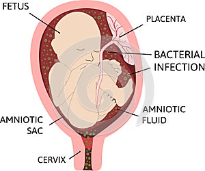 Chorioamnionitis or intra-amniotic infection IAI is an inflammation of the fetal membranes amnion and chorion due to a bacterial photo