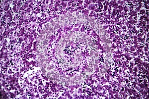 Chronic active hepatitis, light micrograph photo