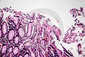 Chronic atrophic gastritis, light micrograph