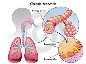 Chronic bronchitis photo