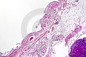 Chronic bronchitis under microscope