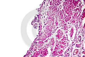 Chronic bronchitis under microscope