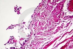 Chronic bronchitis under microscope