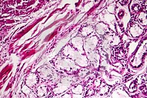 Chronic bronchitis under microscope