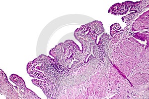 Chronic cholecystitis, light micrograph photo