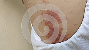 The chronic dermatitis, rash hives, allergy and peeling skin.