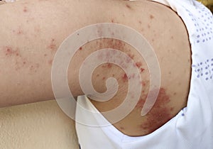 The chronic dermatitis, rash hives, allergy and peeling skin.