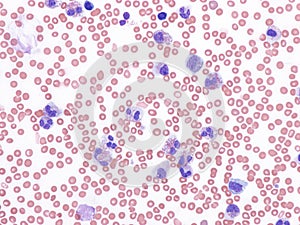 Chronic eosinophilic leukemia.